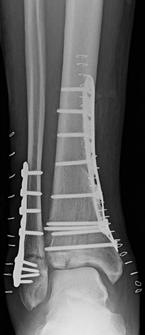 Yakın zamanda tanımlanmış dört kolon sınıflamasında ise, distal tibia ve fibula anatomik