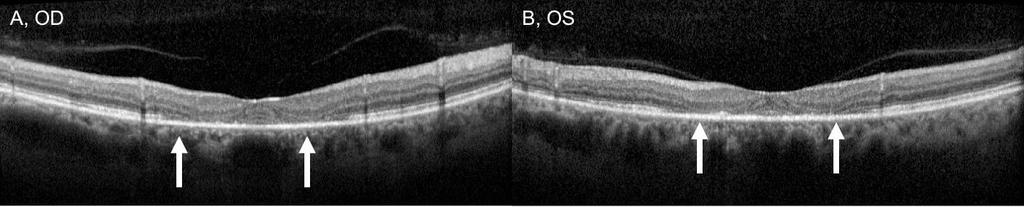 Optik Koherens Tomografi Biyolojik dokulardan yüksek çözünürlükte kesitler almayı sağlayan noninvaziv bir görüntüleme yöntemidir (10).