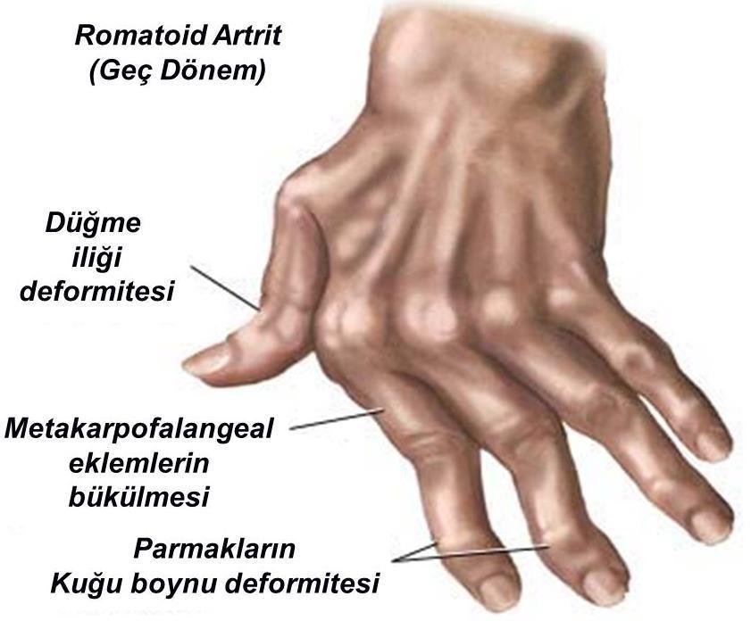 2.5. Romatoid Artrit in Belirti ve Bulguları Romatoid artritin en belirgin belirtisi, eklemlerde görülen şişliklerdir.