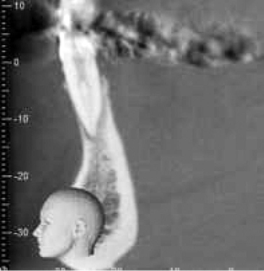 RESİM 2: Hastada sağ alt lateral dişin sagital kesit görüntüsünde Vertucci Tip III kök kanal morfolojisi izlenmiştir.