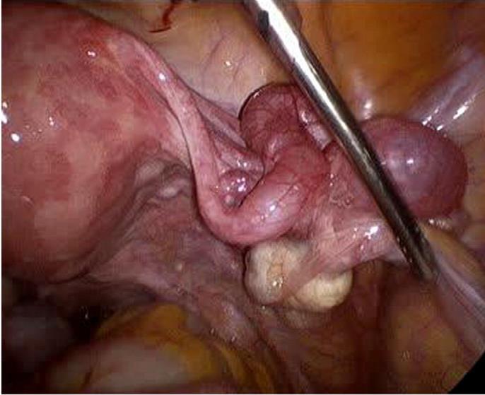 Distal Tubal Oklüzyon Mikrocerrahi ile salpingoneoostomi (L/T) kümülatif gebelik %33 (yıl) İntrauterin %77 Ektopik %23 Abortus %15