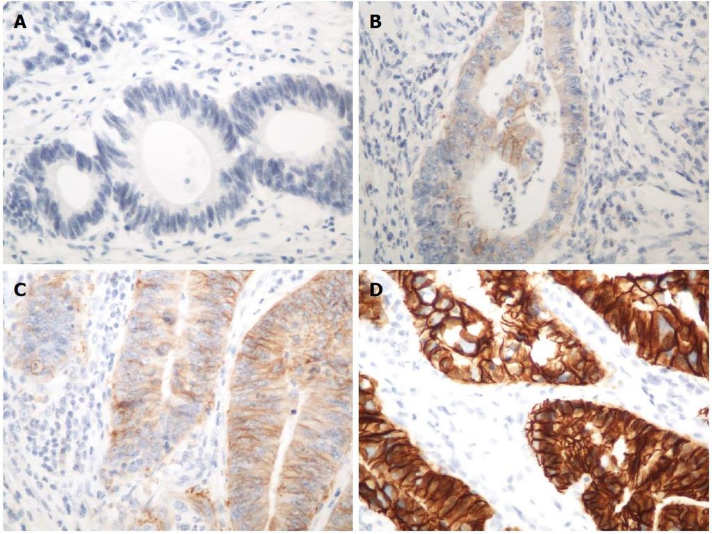 Mide ve Gastroözefagial bileşke karsinomlarında Human Epidermal Growth Factor Receptor (EGFR, HER) 2 Protein ifadesinin immünohistokimyasal