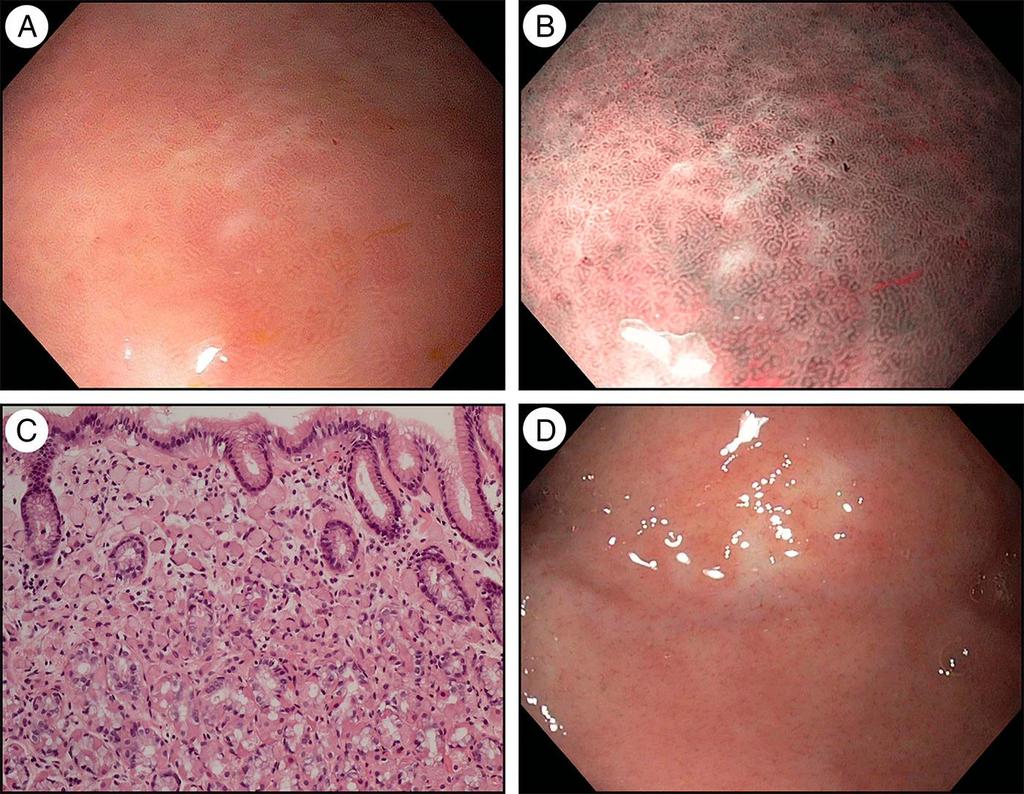 Germline CDH1 mutasyonu olan hastaya ait mide mukozasının endoskopik ve