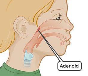 solunumu Horlama, uyku apnesi Sık adenoidit Kronik