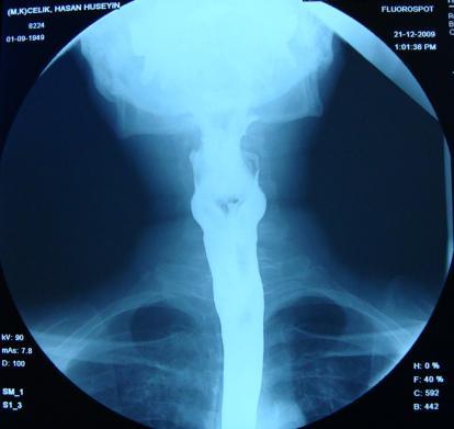 5: Özofagus A-P radyografisi pozisyonu ve radyogramı Hasta