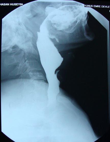 13: Özofagus sol lateral radyografisi pozisyonu ve
