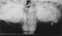 Lateral ve oblik pozisyonlarda tetkik yapılacak taraf filme yakındır. Parotis bezi ortopantomografik yöntemle de görüntülenebilmektedir.