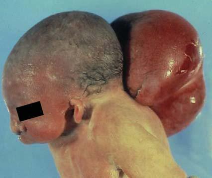 Meckel-Gruber Sendromu perinatal ölümle sonuçlanan otozomal