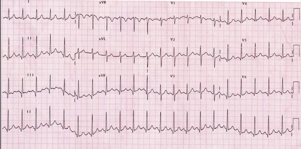 Sinüs taşikardisi EKG Düzenli dar QRS kompleksi taşikardi 100-180 atım/dk P dalgaları normal Her