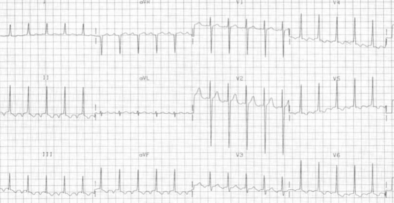 Atrial taşikardi EKG DII, III, avf de
