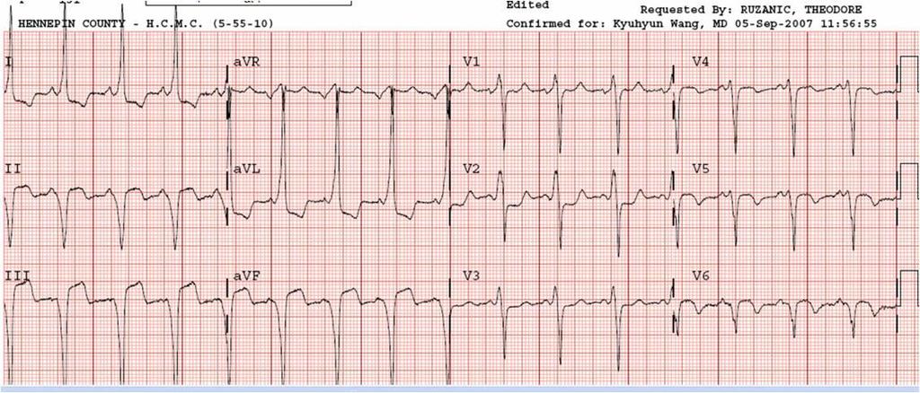 WPW EKG Ventriküler hız 150-250 atım/dk PR mesafesi<120 ms