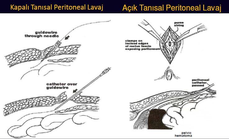 DİAGNOSTİK PERİTONEAL LAVAJ ENDİKASYONLARI Periton irritasyon bulgusu vermeyen kesici alet