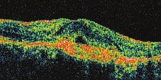 Tüm olgularda lezyon d fl nda kalan bölgelerde retina yüzeyine, retina içine ve retina alt na ait dokular n yans ma özelliklerinde degifliklik yoktu.