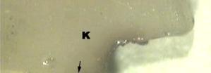Resim 3. ibond uygulanmış örneklerde, hibrit tabakası boyunca oluşan gümüş sızıntısının Stereomikroskop taki görüntüsü (X 40). D: Dentin, K: Kompozit Resim 4.