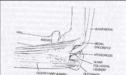 Dirsek seviyesinde ulnar tuzak nöropati Kübital tünel tavanını arkuat ligaman, tabanını mediyal ligaman ve trokleanın oluşturduğu anatomik bir yapıdır Arkuat