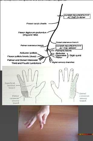 Klinik prezentasyon Duyu kusuru (dorsal ve palmar kısımlar etkilenmiştir) Ağrı Tinel bulgusu +/- Kas gücü kaybı ve atrofi Pençe el deformitesi (ileri vakalarda)