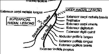 Derin radiyal sinir lezyonu (Posterior interossöz sinir sendromu) Supinatör kasın içinden geçerken Froshe arkadının altında komprese olur Klinik prezentasyon: Dirsek veya