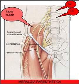Lateral Femoral Kutanöz Sinir Sıkışma Bölgesi Sendrom En sık neden Lateral femoral kutanöz Abdominal