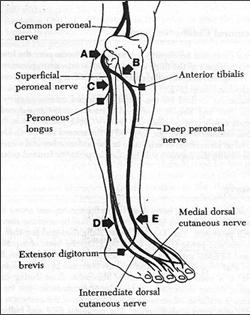 Peroneal sinir tuzaklanma yerleri Fibula başında tuzaklanma (Çapraz bacak sendromu) (A) Derin dal paralizisi (B)