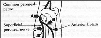 Diz seviyesinde peroneal nöropati Fibula başında sinirin akut kompresyonu sonucu