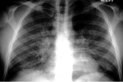 Radyolojik görünüm hiç olmayabilir veya Mediastinal Lap