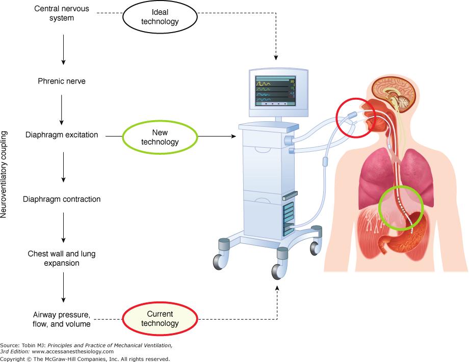 74 Fatma Çiftçi, Akın Kaya NAVA Modunun Temel Prensipleri İlk esasları 15 yıl önce tanımlanan neurally adjusted ventilatory assist (NAVA), son yıllarda piyasaya sunulan kısmi ventilatuar destek