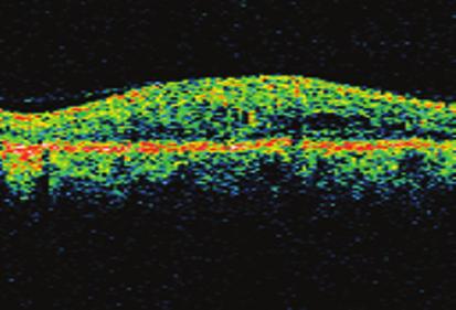 82 Diabetik Maküla Ödeminde Cerrahi Tedavi Resim 1: OCT- Diffüz retinal kalınlaşma. Resim 2: OCT- Foveada seröz dekolman.