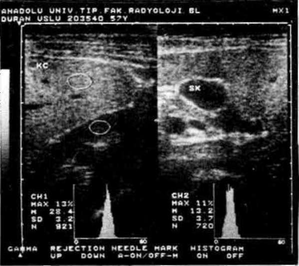 Diffüz Karaciğer Parankim Hastalıklarında Ultrasonografİnin önemi/yildiz, ERENOÖLU Şekil 5.