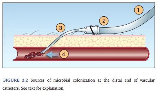 Patogenez Kateter göbeği kontaminasyonuintraluminal yol Kontamine infüzat Cilt