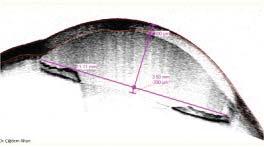 Fakoantijenik (Fakoanaflaktik) glokom (iii) Lens partikül glokomu -Kapalı açılı glokomlar (i) Fakomorfik glokom (ii) Lens dislokasyonu Fakolitik glokom (Lens protein glokomu): Hipermatür veya matür