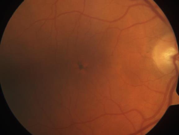 2 Retina Pigment Epiteli Değişiklikleri RPE nde fokal atrofi, fokal hiperpigmentasyon (Şekil 2.