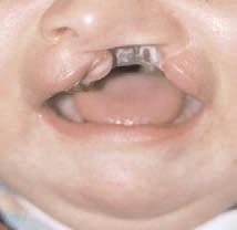 Örne in, üst dudaktan tümör ç kar lmas sonucu oluflan duda n yar s na yak n kay plar alt duda n dörtte birini içeren k sm yla onar labilir.