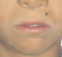 Do ufltan dudak ve damak yar olgusu (üstte); dudak ve damak onar m ndan 8 y l sonras (altta).