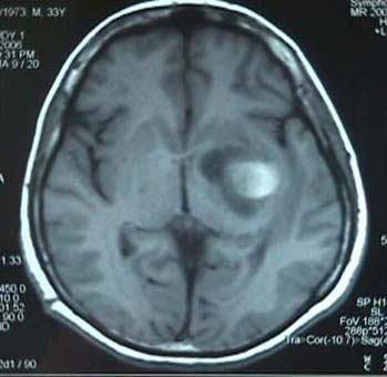 Şekil 4: T1 ağırlıklı kontrastlı MRI sol temporal bölgede halka