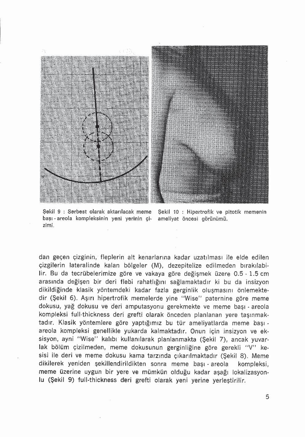 Şekil 9 : Serbest olarak aktarılacak meme başı - areola kompleksinin yeni yerinin çi~ zimi. Şekil 10 : Hipertrofik ve pitotik memenin ameliyat öncesi görünümü.