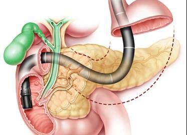 Endoscopic retrograde cholangiopancreatograp hy (ERCP), yandan görüş sağlaya ve safrapankreas ka