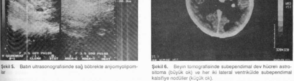 BEYİN VE RENAL TUTULUMU OLAN BİR TUBEROSKLEROZ OLGUSU 87 TARTIŞMA TS, klasik belirtileri mental retardasyon, epilepsi ve adenoma sebaseum olan otozomal dominant geçiş gösteren bir nörokutanöz