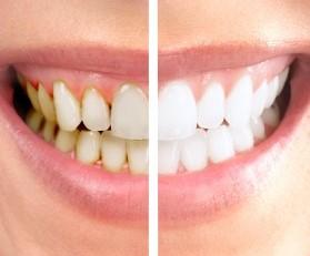 Randevu Almak için Arayın: 0 505 402 41 41 ve 0 262 644 91 62 DİŞ BEYAZLATMA Çeşitli nedenlerle renk değiştirmiş dişlerin rengini kişiye özel birkaç ton açmak için uygulanan işleme diş beyazlatma