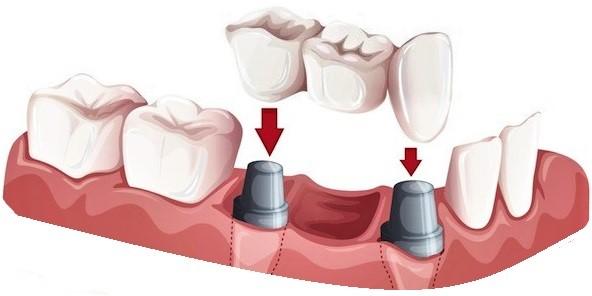 Kaplama, altındaki hasar görmüş dişe tam uyum göstererek, dişi her taraftan saran dental restorasyondur.