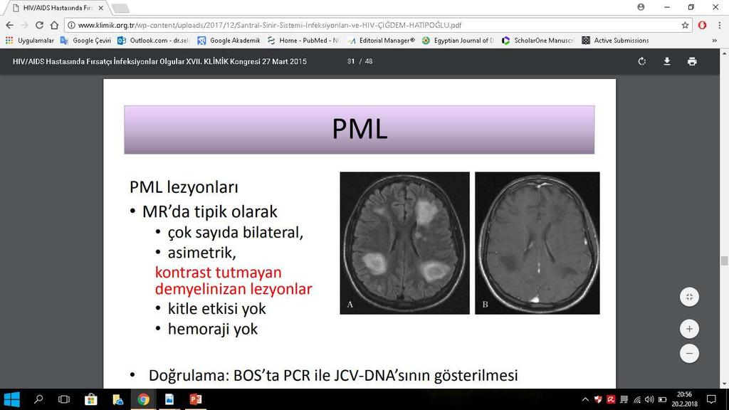 JCV PML TANI Klinik Radyolojik Çok sayıda bilateral, asimetrik Kontrast tutmayan demiyelinizan lezyonlar Kitle etkisi yok Hemoraji yok Natalizumab ilişkili PML ve PML IRIS te