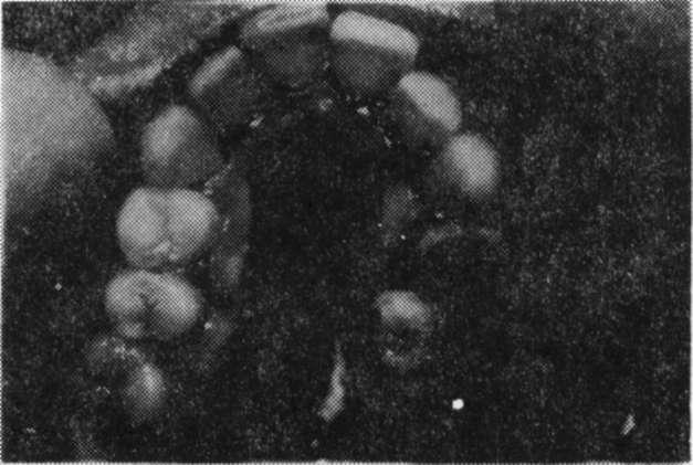 RME Osteotomisi G.Ü. Dişhek. Fak. Der., 1996 tedavisi uygulanacak erişkin hastalarda, RME uygulamasının, cerrahi girişim ile birlikte, kombine olarak yürütülmesi zorunluluğunu ortaya koymaktadır.