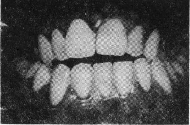 Yapılan ağız içi muayenede, bilateral maksiller çapraz kapanış, ön bölgede açık kapanış saptanmıştır. Damak kubbesi derin olup, üst 2. premolar palatinalde konumlanmıştır (Resim 1, 2).