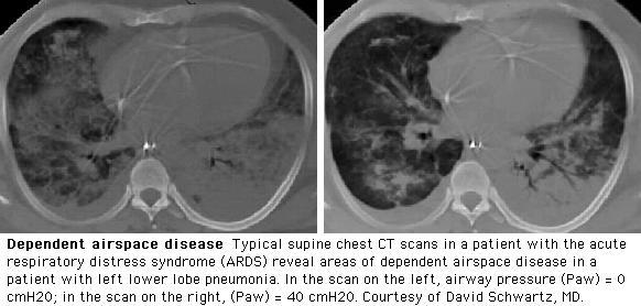 Prone pozisyon ARDS In prone position, there is higher dependent