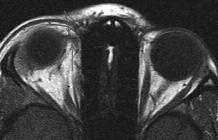 15 1.25 RE SİM 4: T1 ağırlıklı aksiyal kesit (masaj sonrası). Sağ tendon-troklea kompleksi ve üst oblik tendonu masaj öncesine göre daha incelmiş görümlü. Sağ: Brown sendromu, sol: Normal.