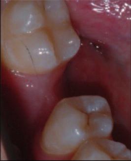 RESİM 1: 46 no lu diş bölgesinin ortodontik tedavi ve kret rekonstrüksiyonu öncesi