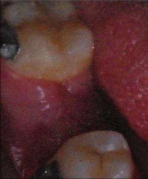 herhangi bir sorunun olmadığı görülmüştür (Resim 8, 9). RESİM 5: 46 no lu diş bölgesine yapılan kret rekonstrüksiyonu sonrası dördüncü aydaki ağız içi görüntüsü.
