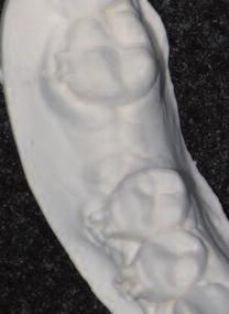 RESİM 7: Kret augmentasyonu yapılan 46 no lu diş bölgesinin radyografik görüntüsü.