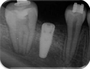 RESİM 8: 46 no lu diş bölgesine yerleştirilen implantın radyografik görüntüsü.