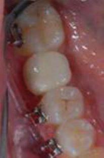 Sabit ortodontik tedavi ile distalizasyon sağlanan olgularda distalize edilen dişin mezialindeki alveolar krette bukkolingual olarak incelme görülebilmektedir.