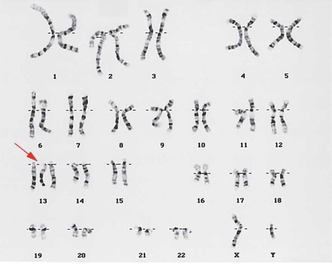 2.2.2 Trizomi - Patau Sendromu İlave kromozom kromozom 13 tür, (47,+13).